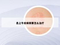 患上牛皮癣需要怎么治疗