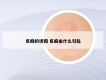 皮癣的诱因 皮癣由什么引起