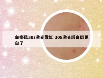 白癜风308激光发红 308激光后白斑更白了