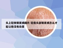 头上轻微银屑病图片 轻度头部银屑病怎么才能让他没有白屑