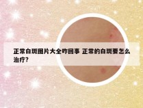 正常白斑图片大全咋回事 正常的白斑要怎么治疗?