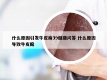 什么原因引发牛皮癣39健康问答 什么原因导致牛皮廨