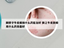 脚脖子牛皮癣抹什么药能治好 脚上牛皮肤癣用什么药膏最好