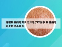 得银屑病的地方长出汗毛了咋回事 银屑病毛孔上出现小红点