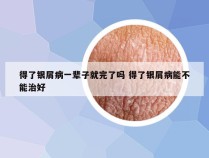 得了银屑病一辈子就完了吗 得了银屑病能不能治好