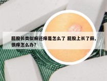 屁股长类似癣还痒是怎么了 屁股上长了藓,很痒怎么办?