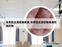 寻常型点滴状银屑病 寻常型点滴状银屑病外用药物