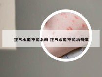 正气水能不能治癣 正气水能不能治癣痒