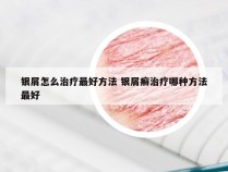 银屑怎么治疗最好方法 银屑癣治疗哪种方法最好