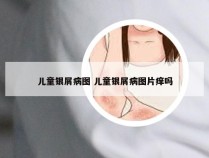 儿童银屑病图 儿童银屑病图片痒吗