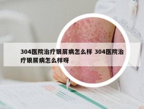 304医院治疗银屑病怎么样 304医院治疗银屑病怎么样呀