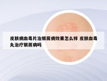 皮肤病血毒片治银屑病效果怎么样 皮肤血毒丸治疗银屑病吗