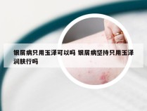 银屑病只用玉泽可以吗 银屑病坚持只用玉泽润肤行吗