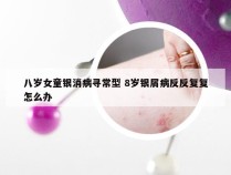 八岁女童银消病寻常型 8岁银屑病反反复复怎么办