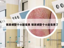 银屑病整个小腿变黑 银屑病整个小腿变黑了