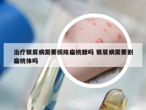 治疗银屑病需要摘除扁桃腺吗 银屑病需要割扁桃体吗