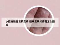 小孩皮肤容易长皮癣 孩子皮肤长癣是怎么回事