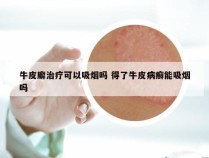 牛皮廨治疗可以吸烟吗 得了牛皮病癣能吸烟吗