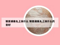 银屑病睾丸上抹什么 银屑病睾丸上抹什么药膏好