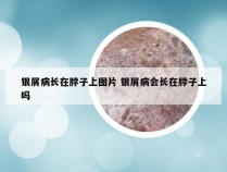 银屑病长在脖子上图片 银屑病会长在脖子上吗