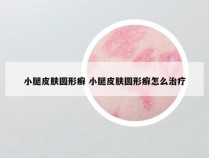 小腿皮肤圆形癣 小腿皮肤圆形癣怎么治疗