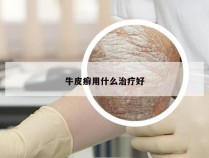 牛皮癣用什么治疗好