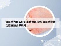 银屑病为什么好的皮肤也起皮呢 银屑病好转之后皮肤会干裂吗