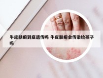 牛皮肤癣到底遗传吗 牛皮肤癣会传染给孩子吗