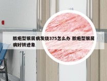 脓疱型银屑病发烧375怎么办 脓疱型银屑病好转迹象