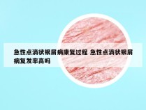 急性点滴状银屑病康复过程 急性点滴状银屑病复发率高吗