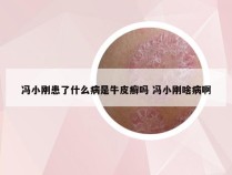 冯小刚患了什么病是牛皮癣吗 冯小刚啥病啊