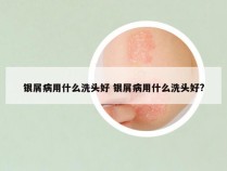 银屑病用什么洗头好 银屑病用什么洗头好?