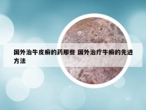 国外治牛皮癣的药那些 国外治疗牛癣的先进方法