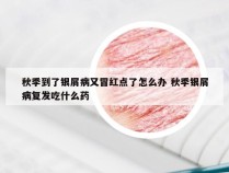 秋季到了银屑病又冒红点了怎么办 秋季银屑病复发吃什么药