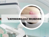 牡蛎壳银屑病HLAB27 银牡蛎的功效