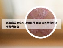 银屑病关节炎可以哺乳吗 银屑病关节炎可以哺乳吗女性