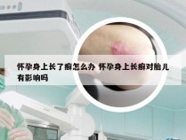 怀孕身上长了癣怎么办 怀孕身上长癣对胎儿有影响吗