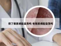 得了银屑病能染发吗 有银屑病能染发吗