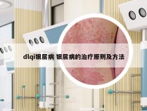 dlqi银屑病 银屑病的治疗原则及方法