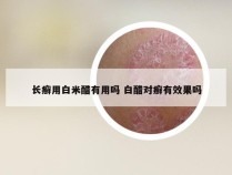 长癣用白米醋有用吗 白醋对癣有效果吗