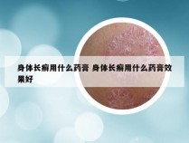 身体长癣用什么药膏 身体长癣用什么药膏效果好