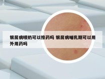 银屑病喂奶可以擦药吗 银屑病哺乳期可以用外用药吗