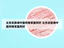 北京皮肤病中医院哪家医院好 北京皮肤病中医院哪家医院好