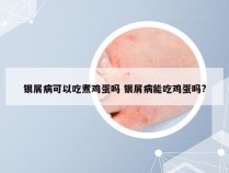 银屑病可以吃煮鸡蛋吗 银屑病能吃鸡蛋吗?