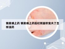 银屑病上药 银屑病上药后红斑面积变大了怎样涂药