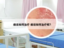 癣该如何治疗 癣该如何治疗呢?