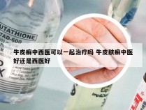 牛皮癣中西医可以一起治疗吗 牛皮肤癣中医好还是西医好