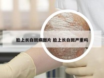 脸上长白斑病图片 脸上长白斑严重吗