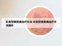 红皮型银屑病治疗方法 红皮型银屑病治疗方法图片