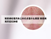 银屑病吃着药身上长红点是什么原因 银屑病用药后红肿痒